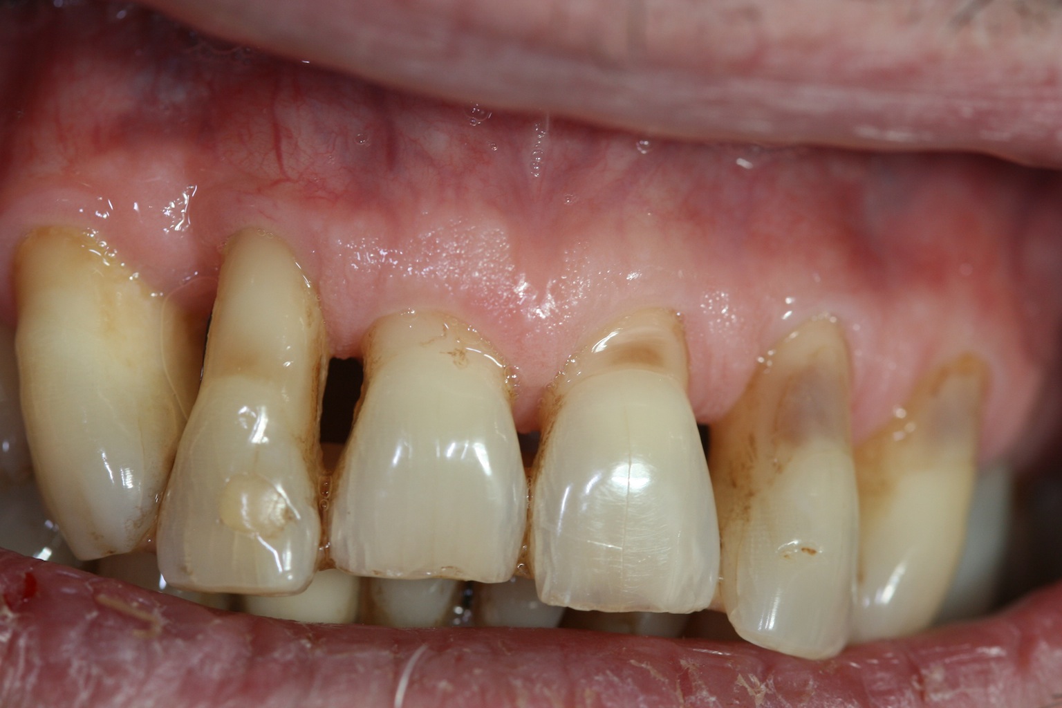 Zahnfleischkorrekturen - parodontitis.com 