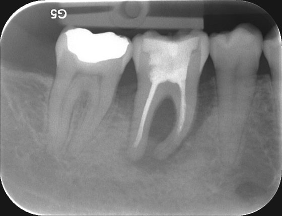 Grau wird wurzelbehandelter zahn Zahnverfärbung nach